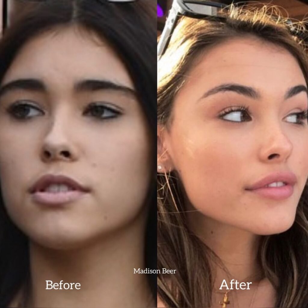 Madison Beer before and after plastic surgery