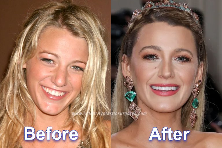 Blake Lively before and after plastic surgery