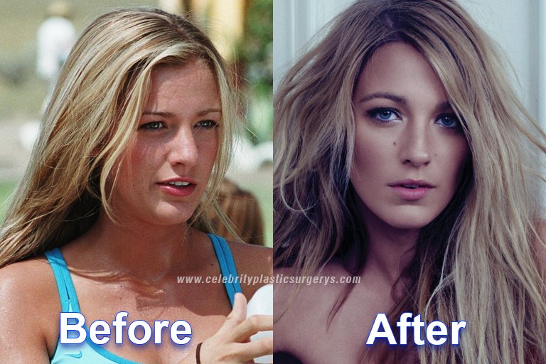 Blake Lively before and after surgery