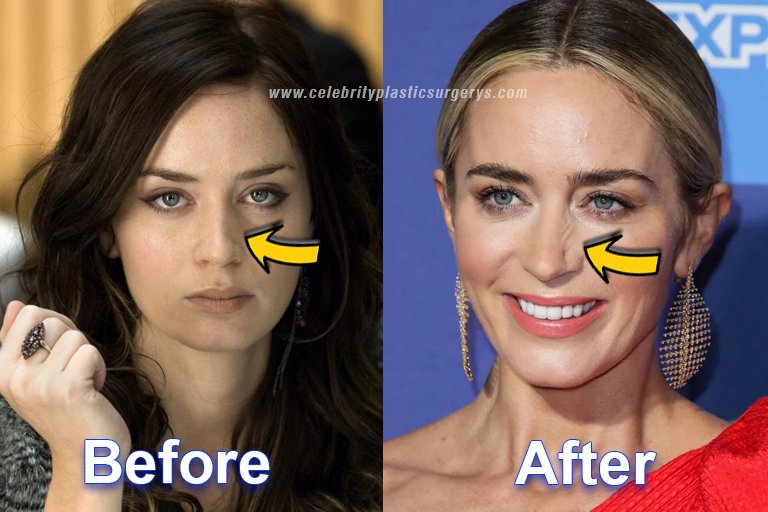 Emily Blunt Nose surgery