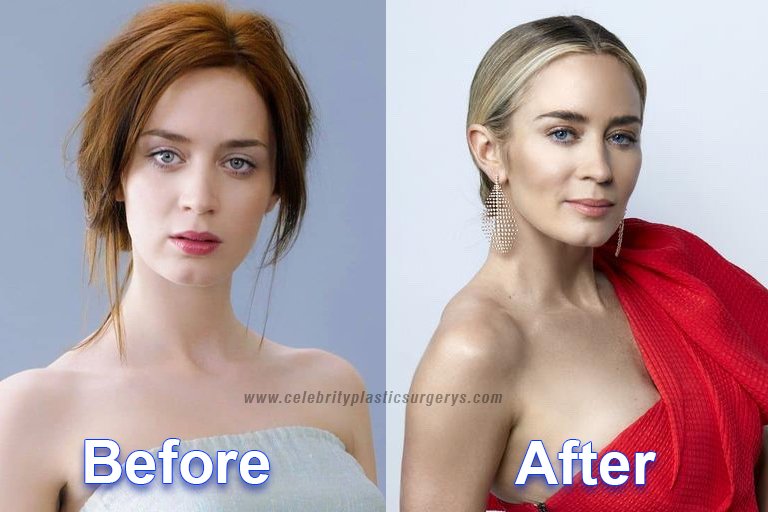 Emily Blunt before and after plastic surgery