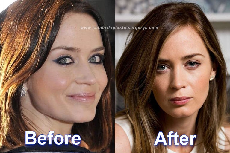 Emily Blunt before and after surgery