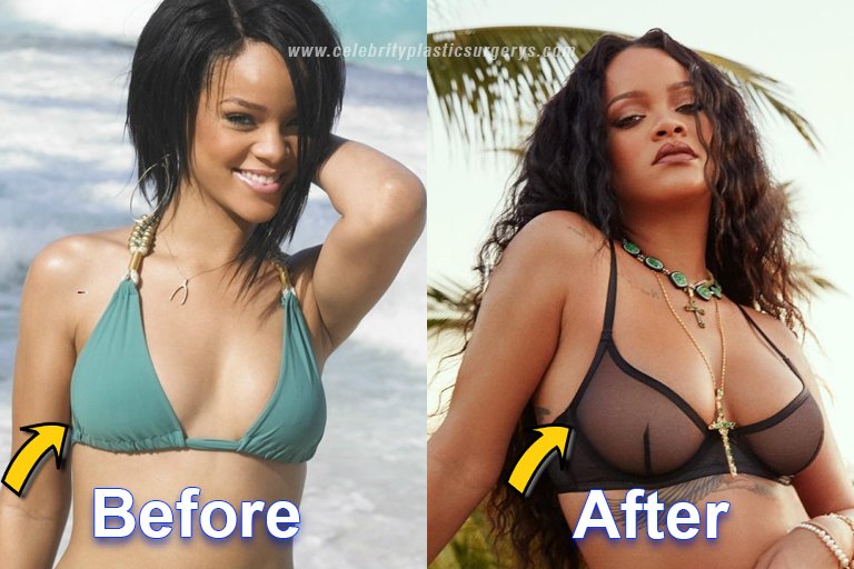 Rihanna Breast Implants Surgery