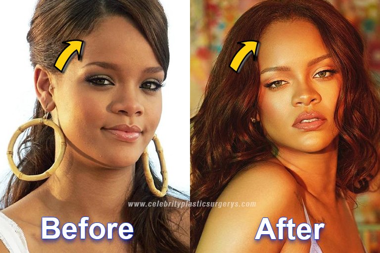 Rihanna Forehead Surgery