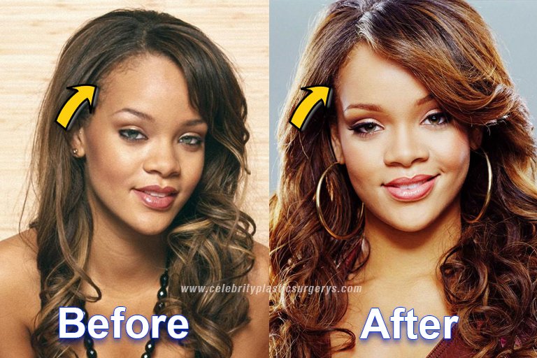 Rihanna Hairline Surgery