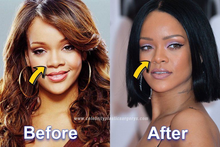Rihanna Nose surgery