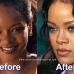 rihanna before and after plastic surgery