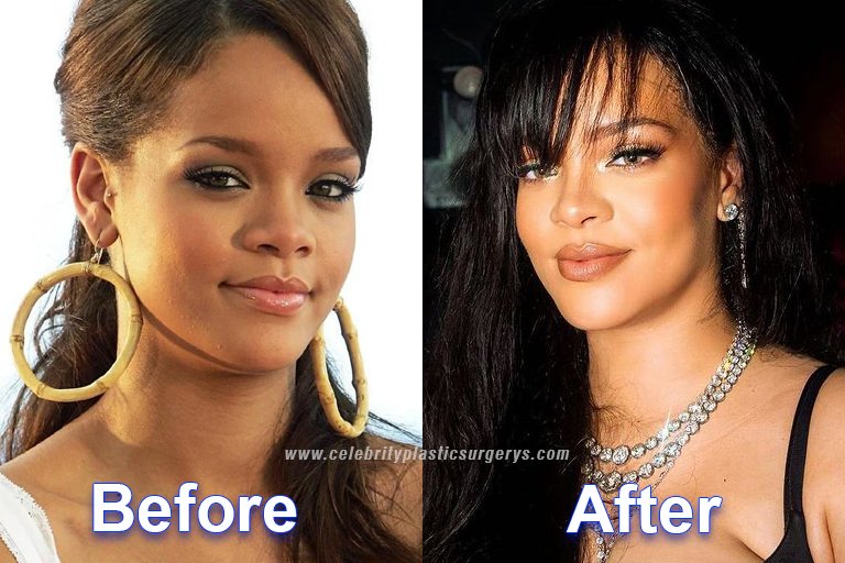rihanna before and after plastic surgery