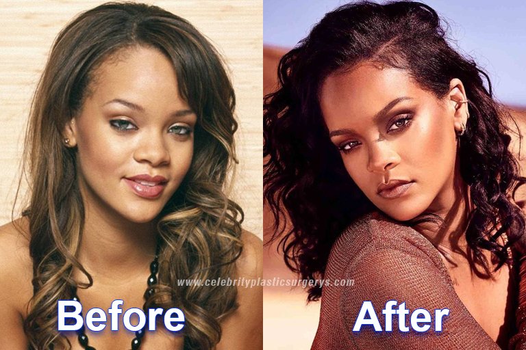 Rihanna before and after surgery